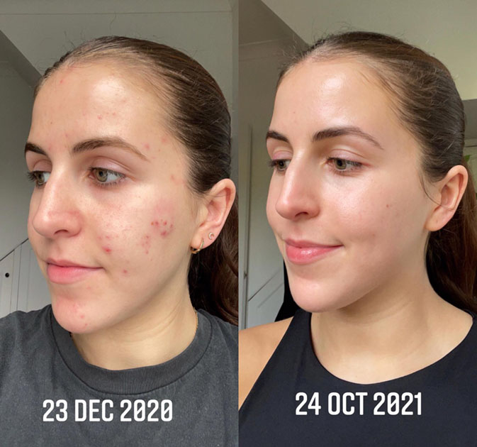 Acne treatment before and after