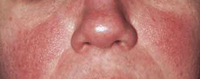 Rosacea