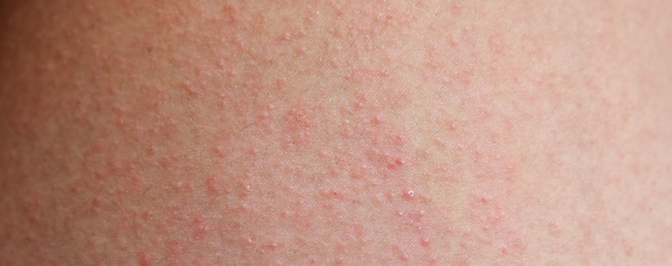 Skin Allergy (patch test)