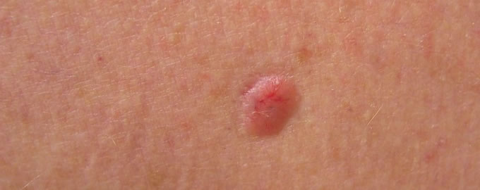 Basal Cell Carcinoma