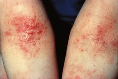 Eczema Infection
