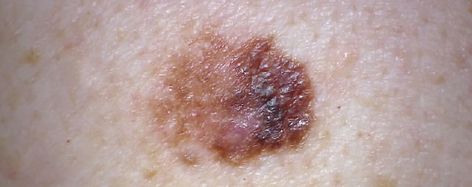 Melanoma