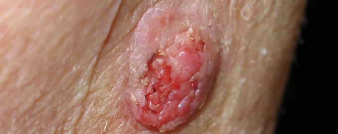 Squamous Cell Carcinoma